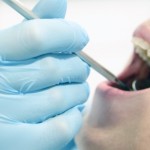 一般人も歯が命　～歯槽膿漏予防への道～＜体験談＞