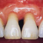 歯周病は万病のもと！歯周病にならない予防法！