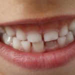 歯が小さい「矮小歯」って改善できるの？