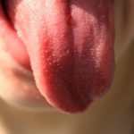若い人に舌がんが増えているってホント？