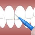 歯ブラシで取れる歯間のプラークは、60％程度！歯間ブラシを習慣化しよう！