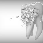 重度の歯周病でも、歯を残せる！？歯周組織再生療法とは？