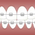 歯科矯正のリスク、「歯根吸収」を知っていますか？